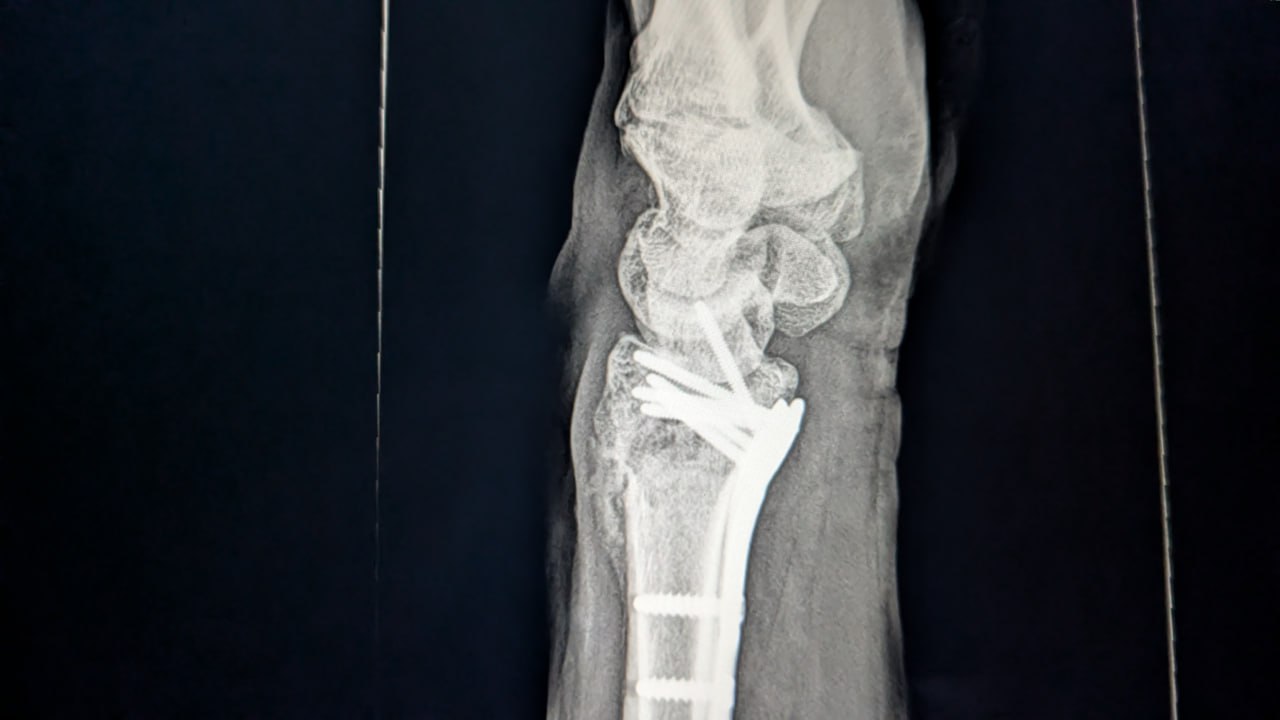 X-ray of Charlie's wrist showing the surgical plate and screws after fracture repair